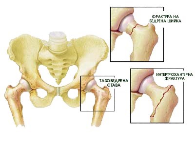 osteoporoza3